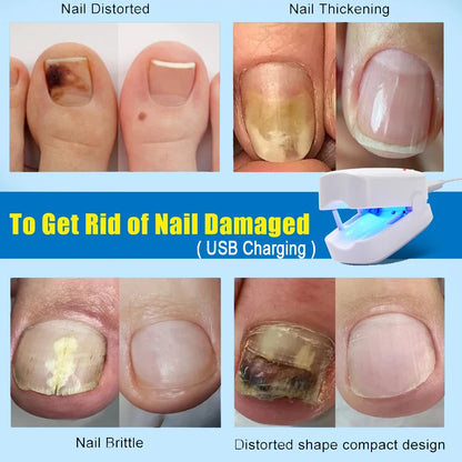 Laser Treatment Device for Nail Fungus Repair