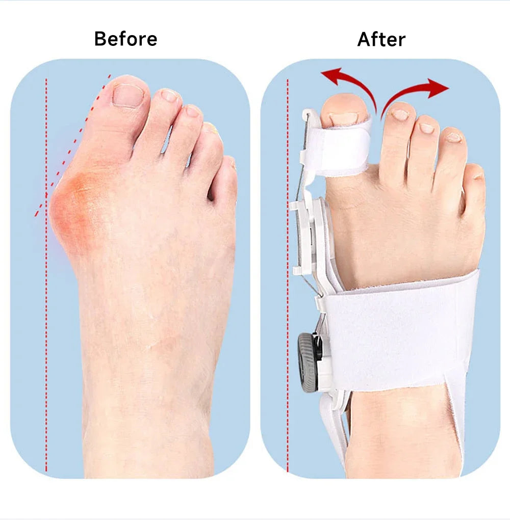 Correcteur d'oignon Hallux Valgus réglable