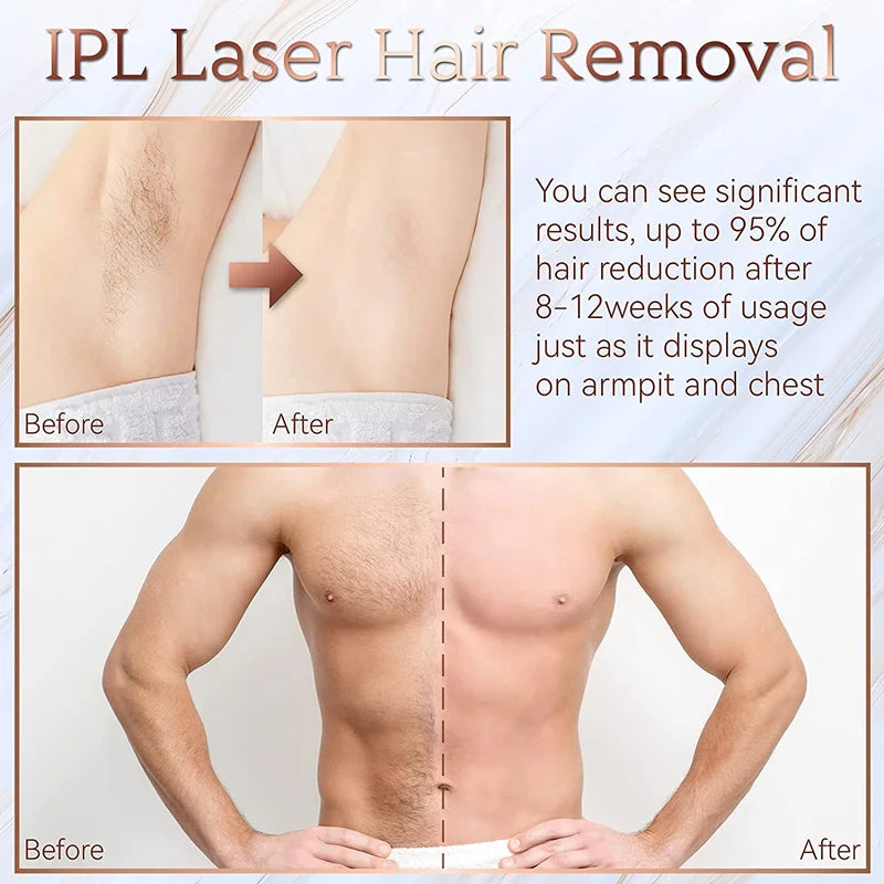 Oumonoka-IPL Laser-Epilierer für Frauen