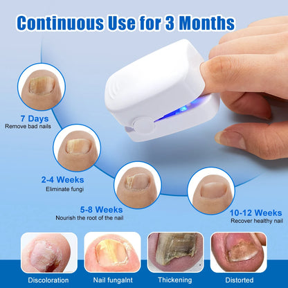 Laser Treatment Device for Nail Fungus Repair